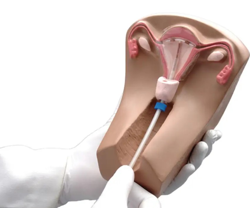 عوارض جدی و نادر دستگاه جلوگیری از بارداری