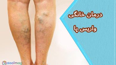 درمان خانگی واریس پا: بهترین روشهای طبیعی برای بهبود علائم واریس