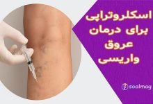 اسکلروتراپی برای درمان عروق واریسی | روش مدرن برای رهایی از رگهای برجسته