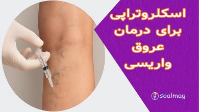 اسکلروتراپی برای درمان عروق واریسی | روش مدرن برای رهایی از رگهای برجسته