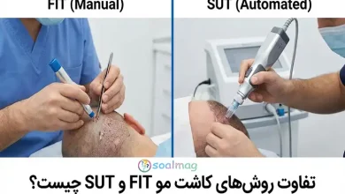 تفاوت روشهای کاشت مو FIT و SUT چیست؟ (مقایسه جامع و تخصصی 1405)