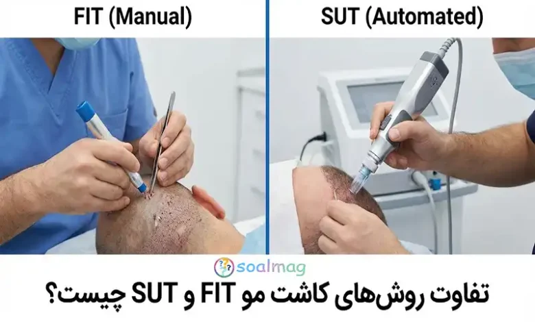تفاوت روشهای کاشت مو FIT و SUT چیست؟ (مقایسه جامع و تخصصی 1405)