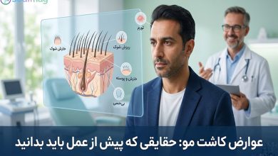عوارض کاشت مو: حقایقی که پیش از عمل باید بدانید (راهنمای جامع)